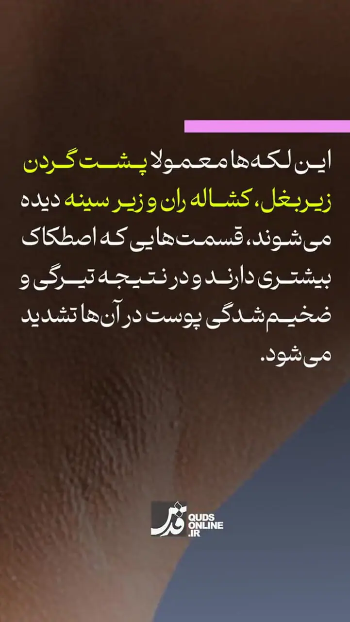 این علامت در پوست نشانه قند خون بالاست