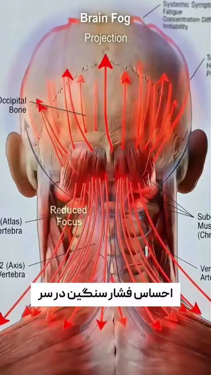 سردردهای ناشی از گرفتگی عضلات گردن